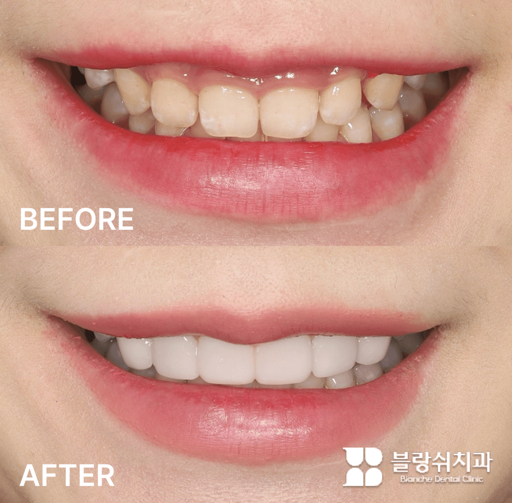 거미스마일과 불규칙한 치열을 개선한 라미네이트 시술 전후 비교
