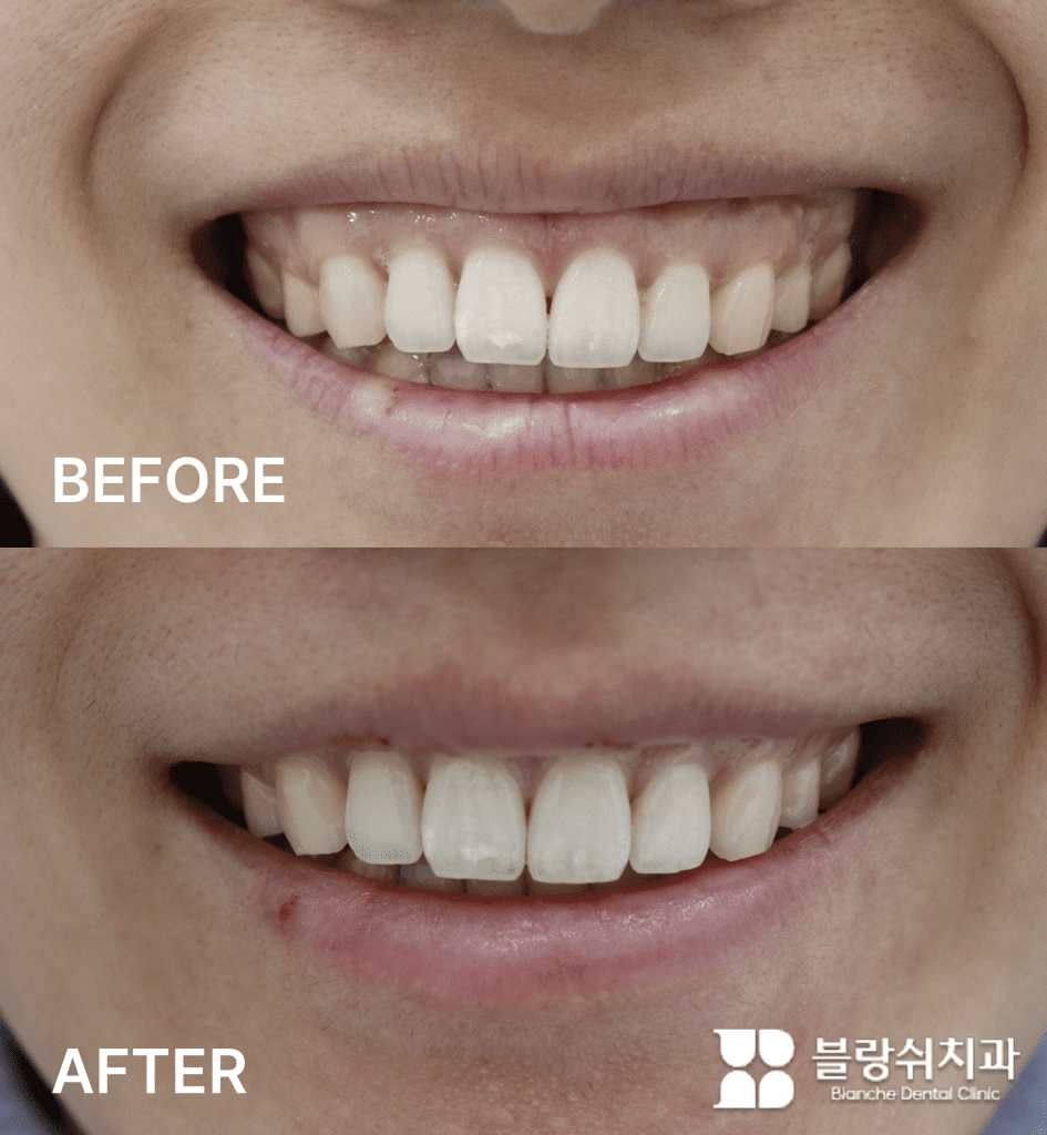 거미스마일 완화를 위한 1차 잇몸성형과 2차 보톡스 시술 비교