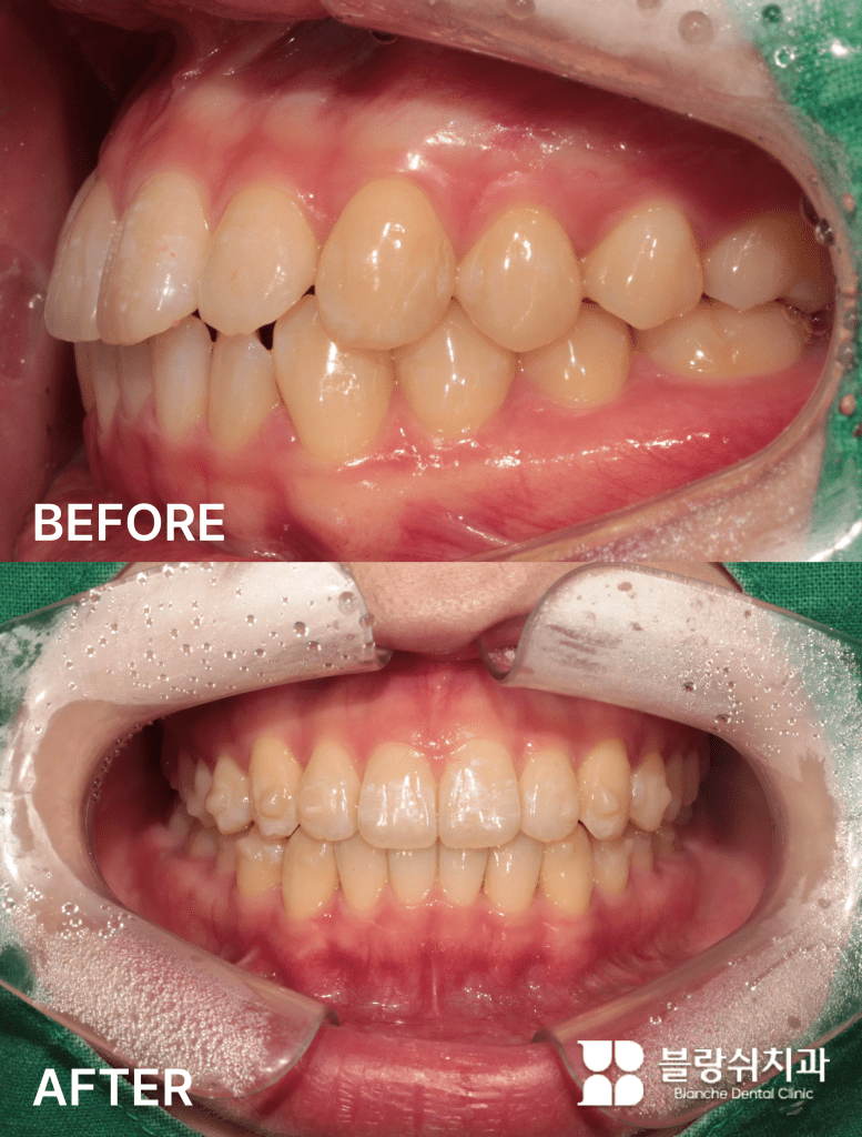 거미스마일과 부정교합을 함께 해결한 치아교정 전후 구강 상태
