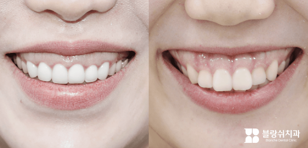 Two smiles with overexposed gums that show spider smile symptoms