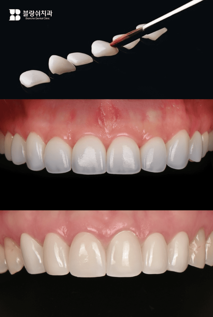 精巧に製作されたブランシュ・ラミネートの成功事例
