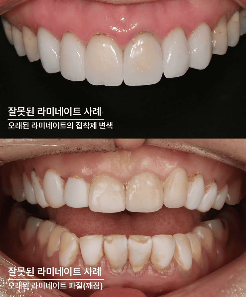 ラミネートの寿命により破折した歯を再施術したビフォーアフター（前後）比較