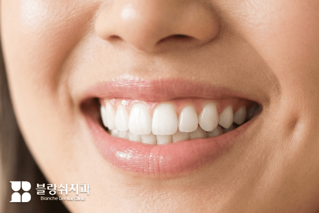 치아미백 후 자신감 있게 미소 짓는 깨끗하고 하얀 치아