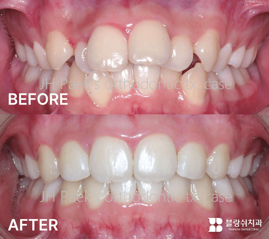 うさぎ歯のインビザライン矯正前後比較事例イメージ（前歯の突出・八重歯の改善）