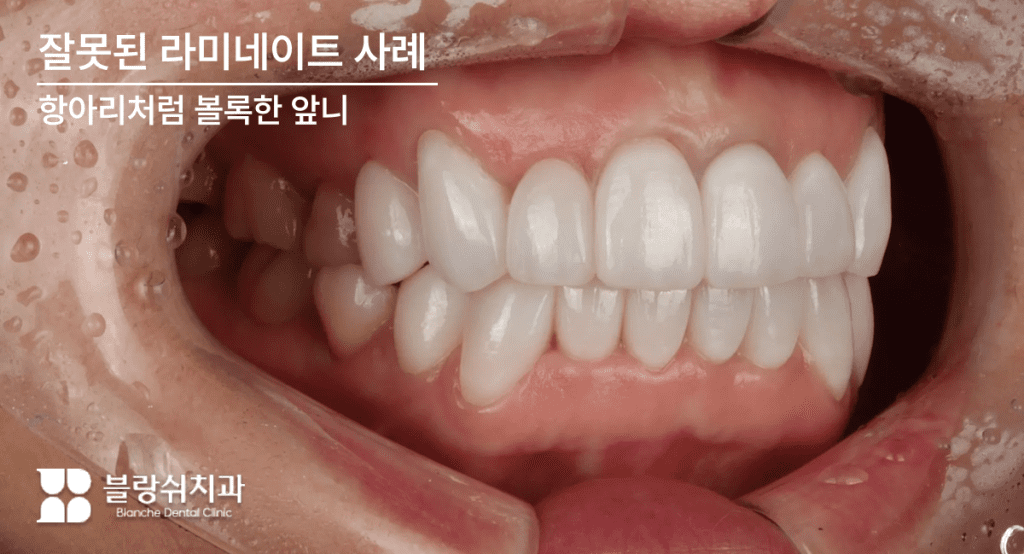 ツボのようにぽっこりと突き出した「突出感」のあるラミネートの副作用事例