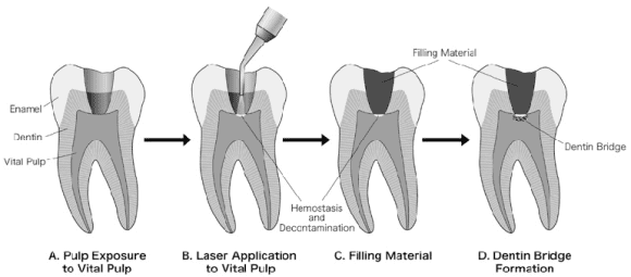 dentin bridge(상아질 다리) 라는 치아의 재생 물질이 만들어지는 과정