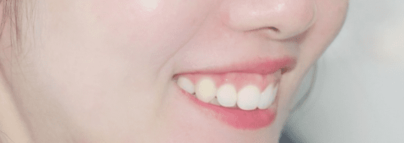 측면에서 본 거미스마일.