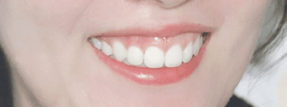 정면에서 본 거미스마일.