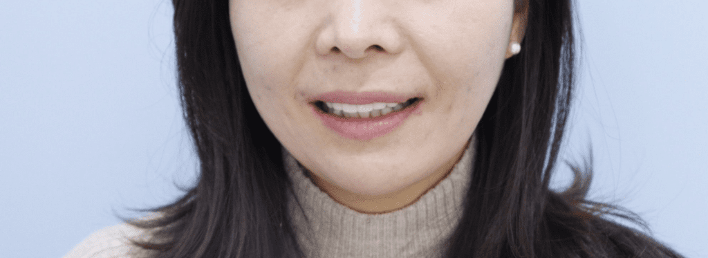 라미네이트, 미백보다 형태 개선에 더 적합한 시술입니다