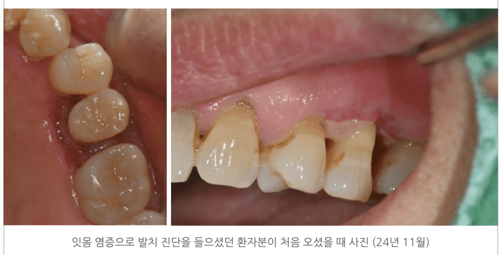 잇몸 염증으로 발치 진단을 들으셨던 환자분이 처음 오셨을 때 사진 (24년 11월)