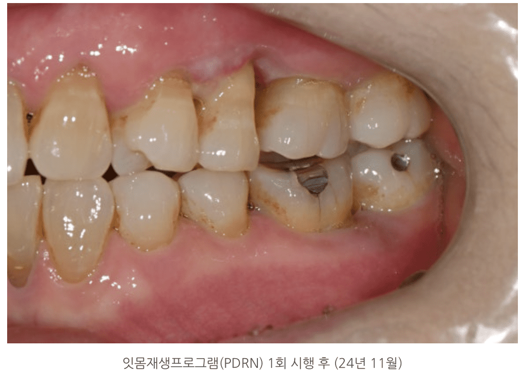잇몸재생프로그램(PDRN) 1회 시행 후 (24년 11월)