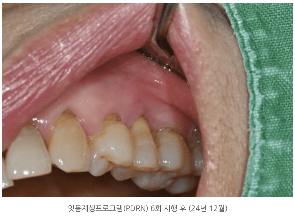 잇몸재생프로그램(PDRN) 6회 시행 후 (24년 12월)