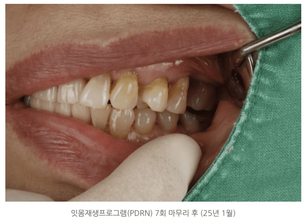 잇몸재생프로그램(PDRN) 7회 마무리 후 (25년 1월)