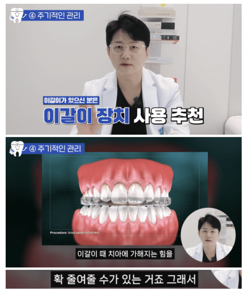 무삭제 라미네이트 수명을 늘리기 위한 방법, 이갈이 방지 장치