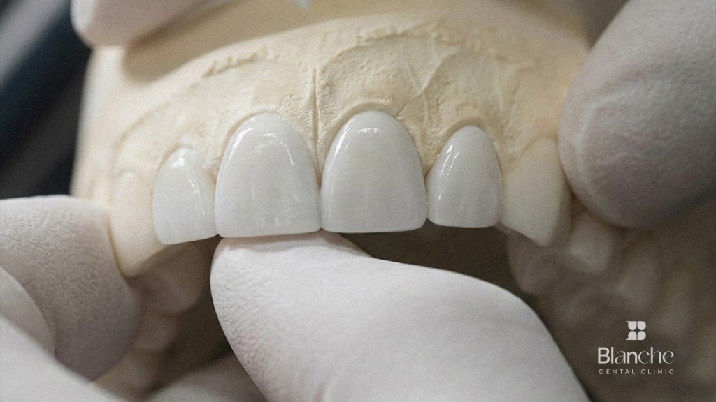 Veneers Korea cost