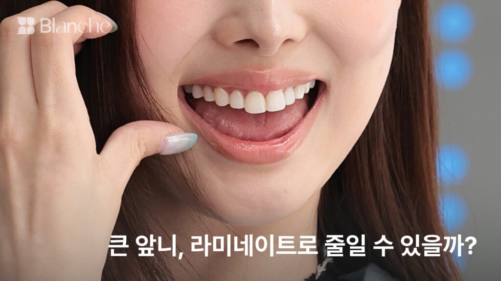 큰 앞니, 라미네이트로 줄일 수 있을까? 커 보이는 이유 3가지와 조정 범위