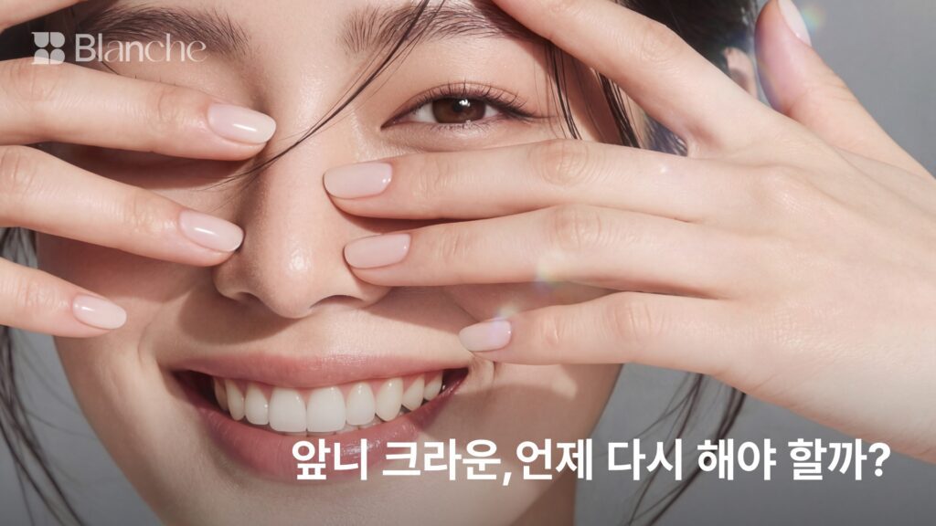 앞니 크라운, 언제 다시 해야 할까? 교체 시기를 가르는 신호 5가지