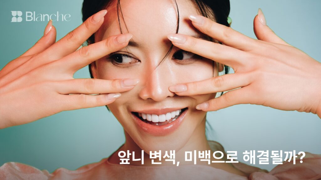 앞니 변색, 미백으로 해결될까? 색과 부위로 갈리는 원인 5가지