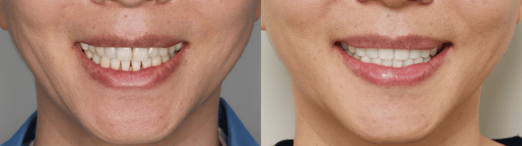 korean-veneers-before-and-after