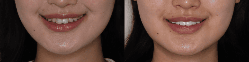 korean-veneers-before-and-after