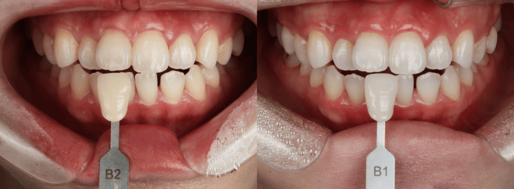 Teeth whitening