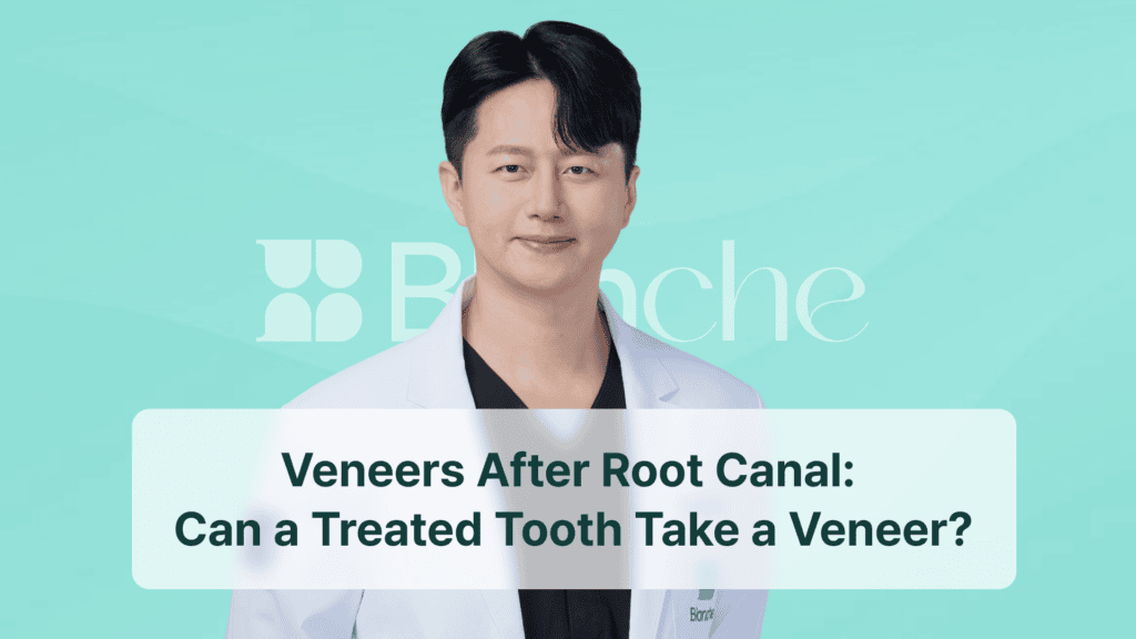 Veneers After Root Canal: Can a Treated Tooth Take a Veneer?