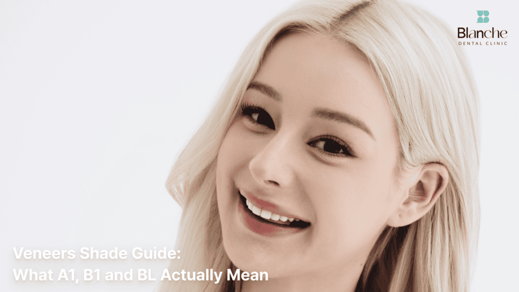 Veneers Shade Guide: What A1, B1 and BL Actually Mean