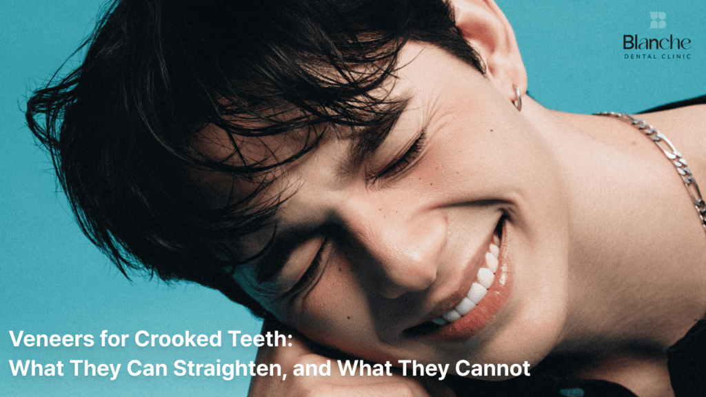 Veneers for Crooked Teeth: What They Can Straighten, and What They Cannot