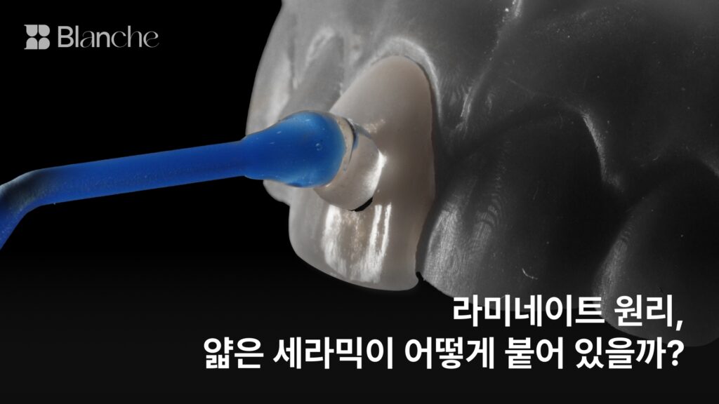 라미네이트 원리, 얇은 세라믹이 어떻게 붙어 있을까?