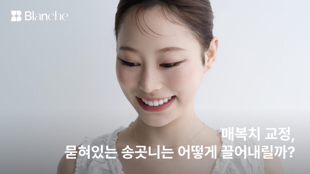 매복치 교정, 묻혀 있는 송곳니는 어떻게 끌어내릴까?