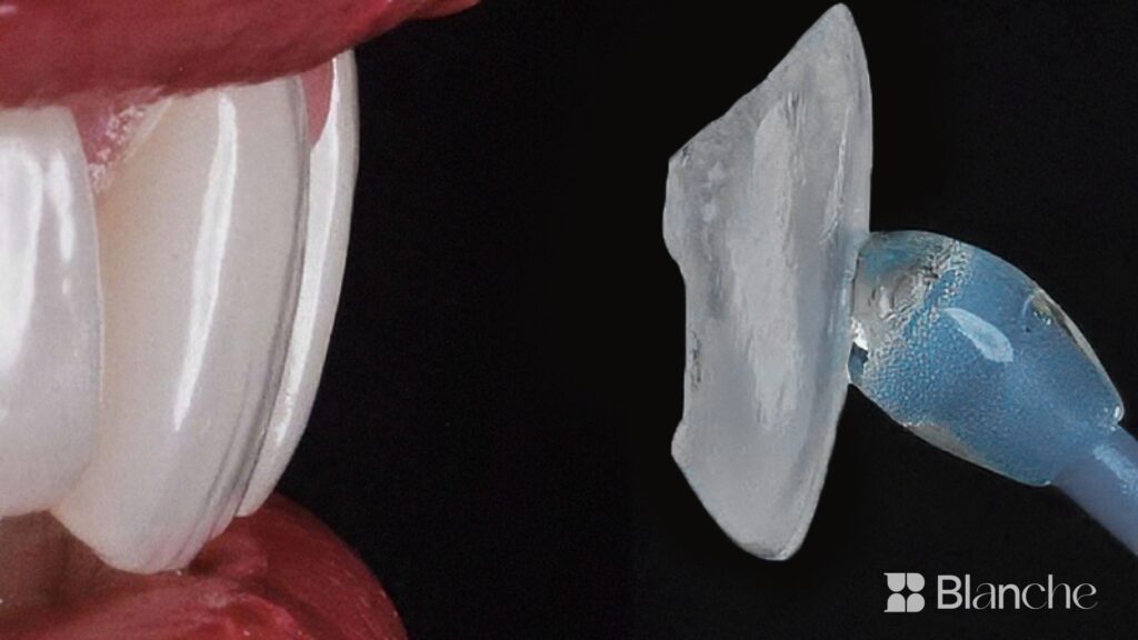 Thin ceramic no prep veneer