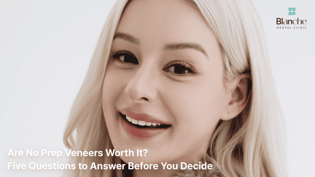 Are No Prep Veneers Worth It? Five Questions to Answer Before You Decide