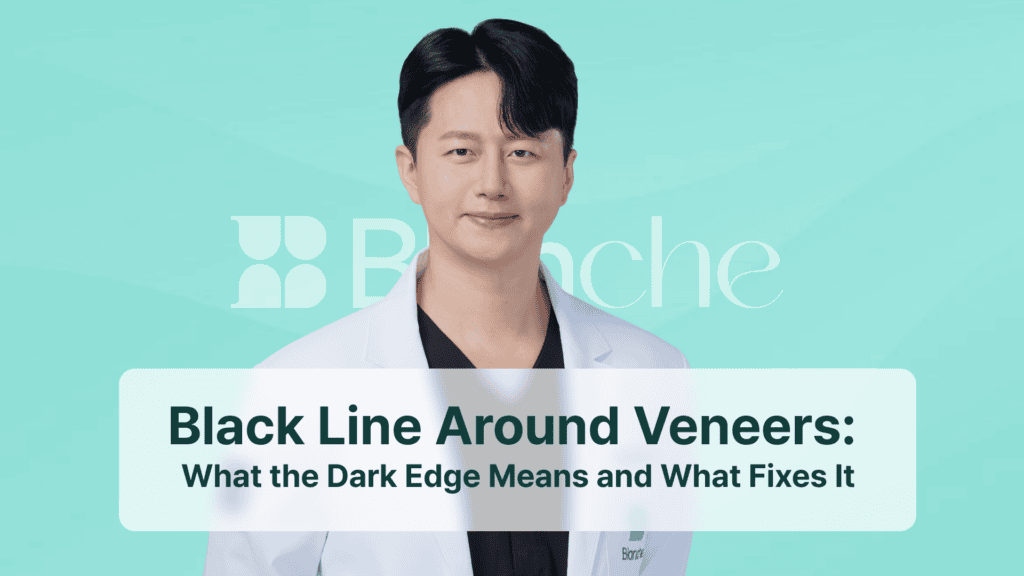 Black Line Around Veneers: What the Dark Edge Means and What Fixes It