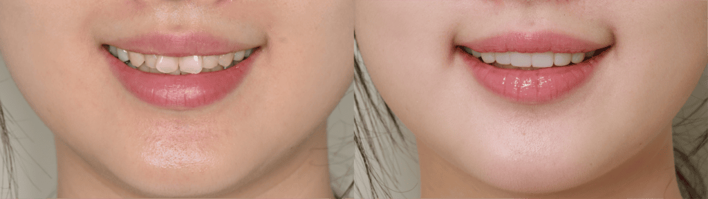 korean-veneers-before-and-after