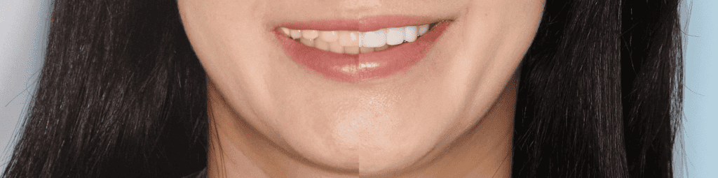 korean-veneers-before-and-after