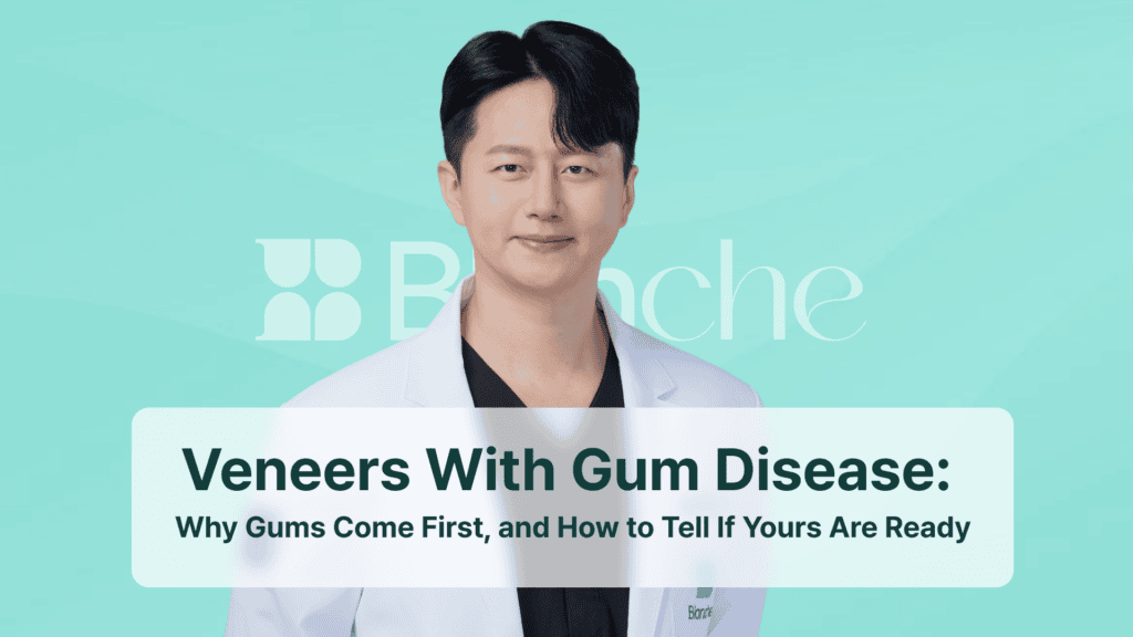 Veneers With Gum Disease: Why Gums Come First, and How to Tell If Yours Are Ready