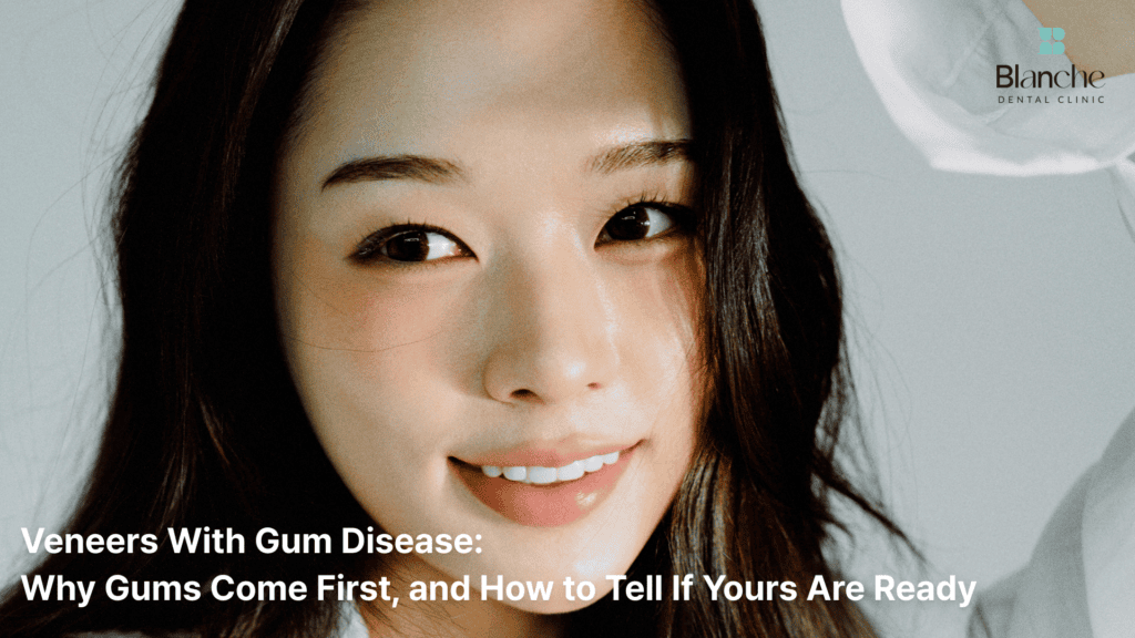 Veneers With Gum Disease: Why Gums Come First, and How to Tell If Yours Are Ready