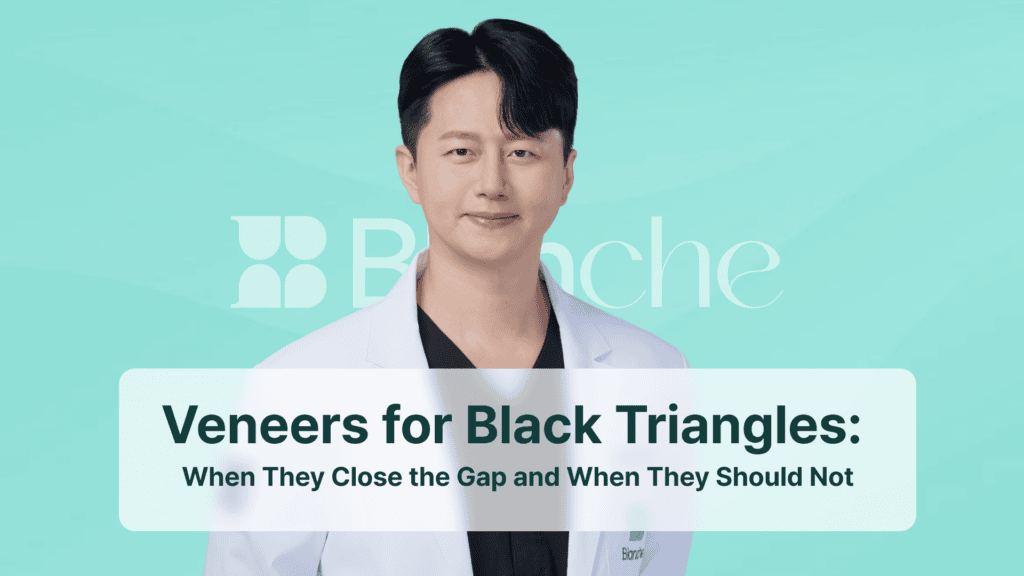Veneers for Black Triangles: When They Close the Gap and When They Should Not