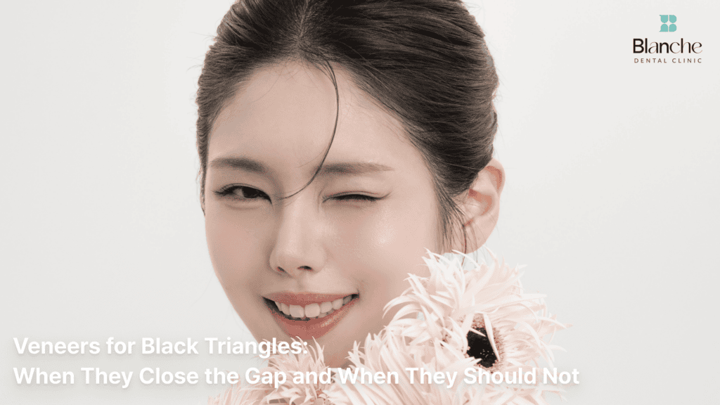 Veneers for Black Triangles: When They Close the Gap and When They Should Not