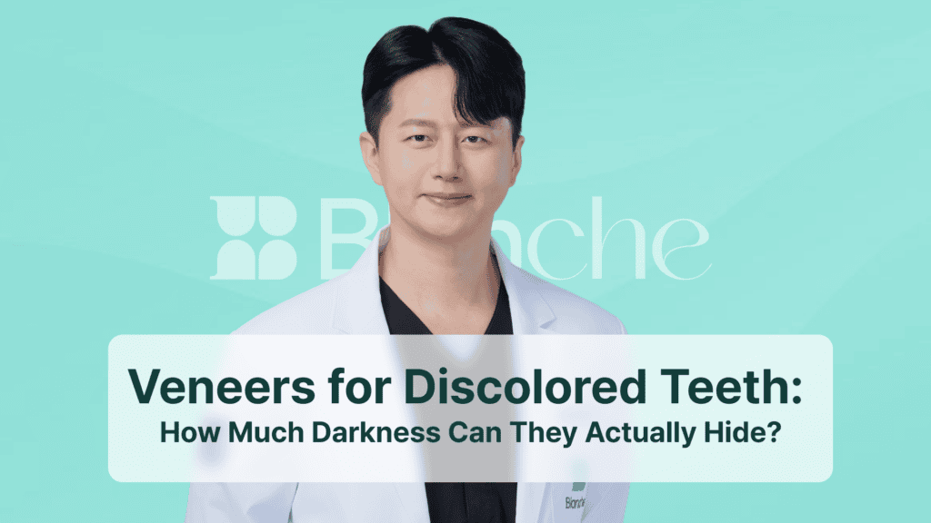 Veneers for Discolored Teeth: How Much Darkness Can They Actually Hide?