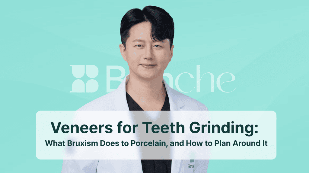 Veneers for Teeth Grinding: What Bruxism Does to Porcelain, and How to Plan Around It