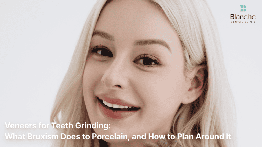 Veneers for Teeth Grinding: What Bruxism Does to Porcelain, and How to Plan Around It