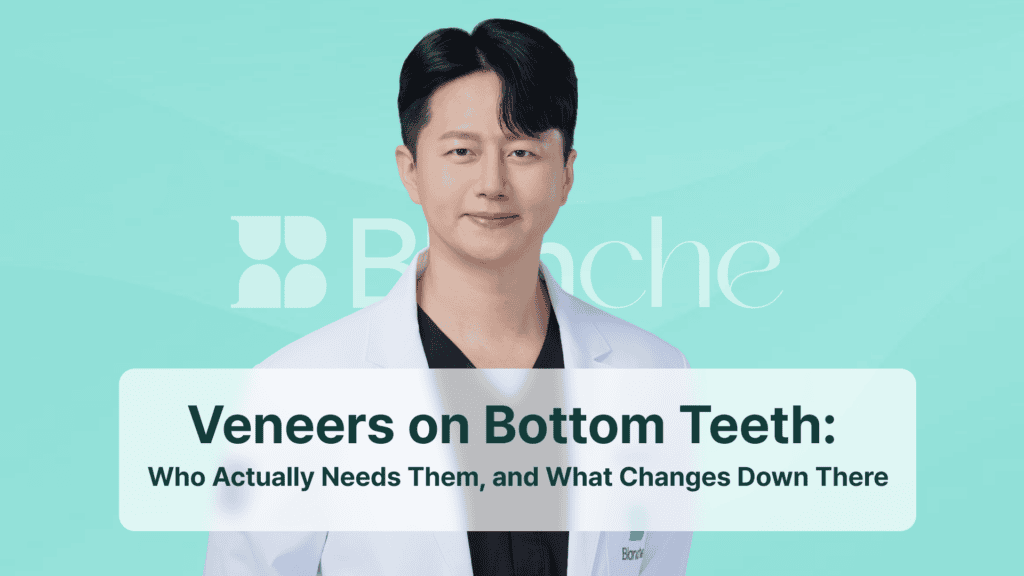 Veneers on Bottom Teeth: Who Actually Needs Them, and What Changes Down There