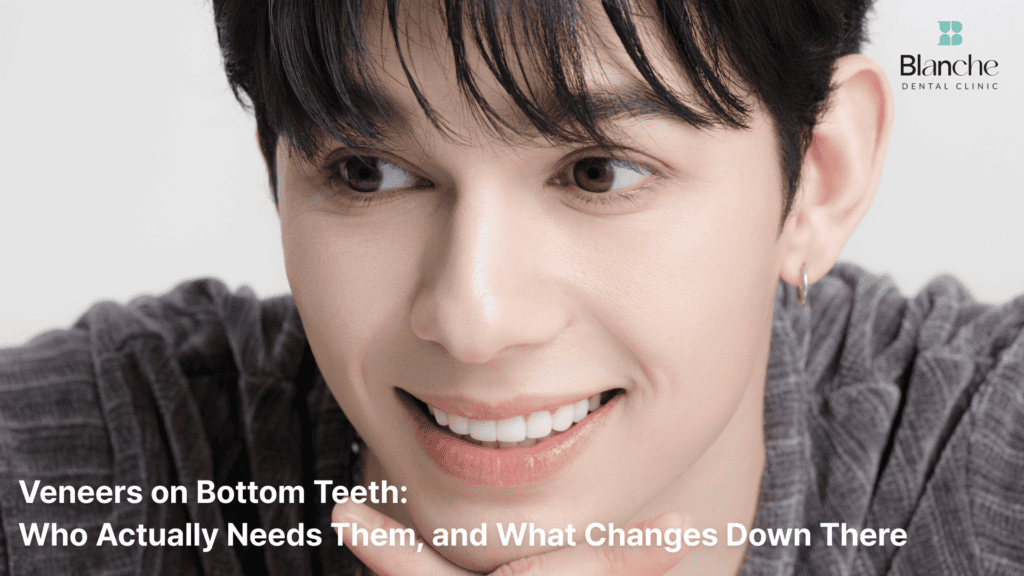 Veneers on Bottom Teeth: Who Actually Needs Them, and What Changes Down There