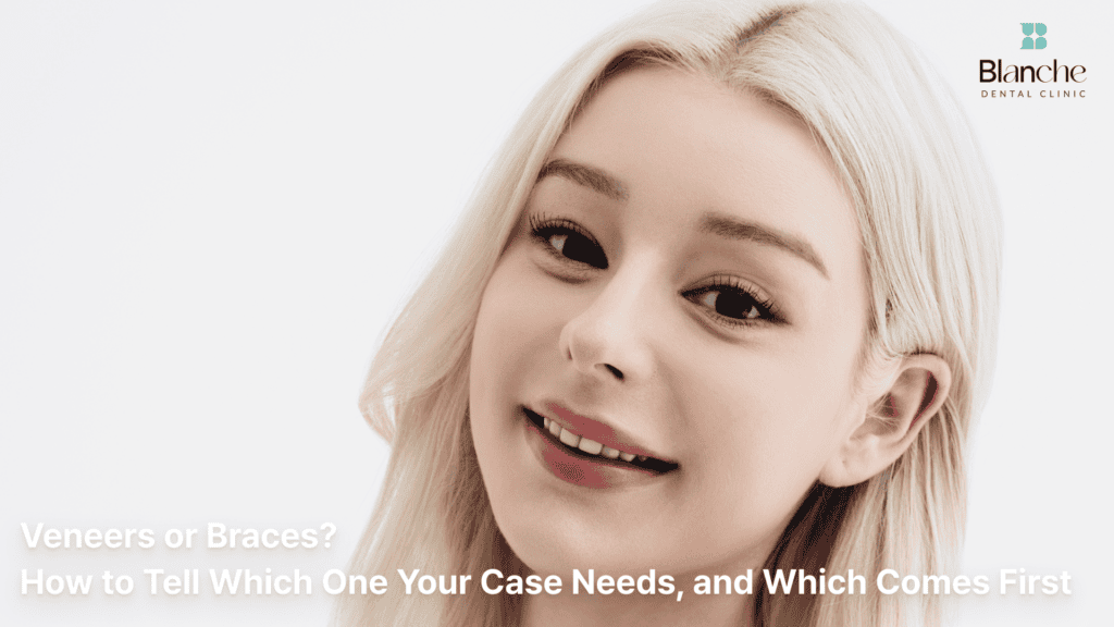 Veneers or Braces? How to Tell Which One Your Case Needs, and Which Comes First