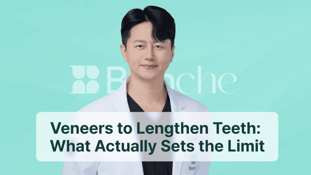 Veneers to Lengthen Teeth: What Actually Sets the Limit