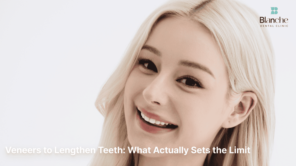 Veneers to Lengthen Teeth: What Actually Sets the Limit