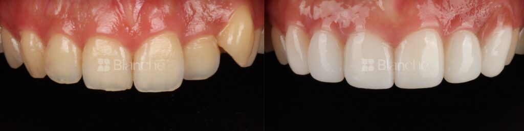 블랑쉬 라미네이트 전후사진