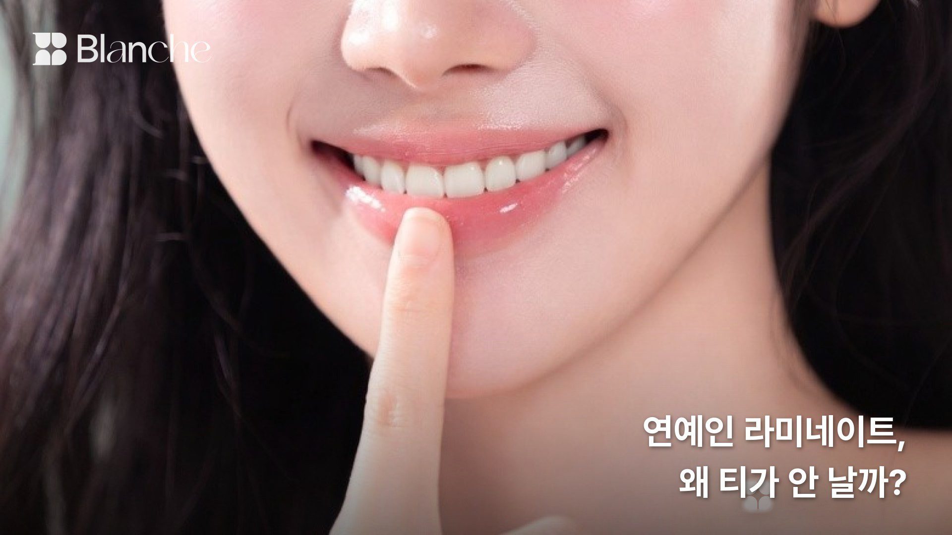 연예인 라미네이트, 왜 티가 안 날까
