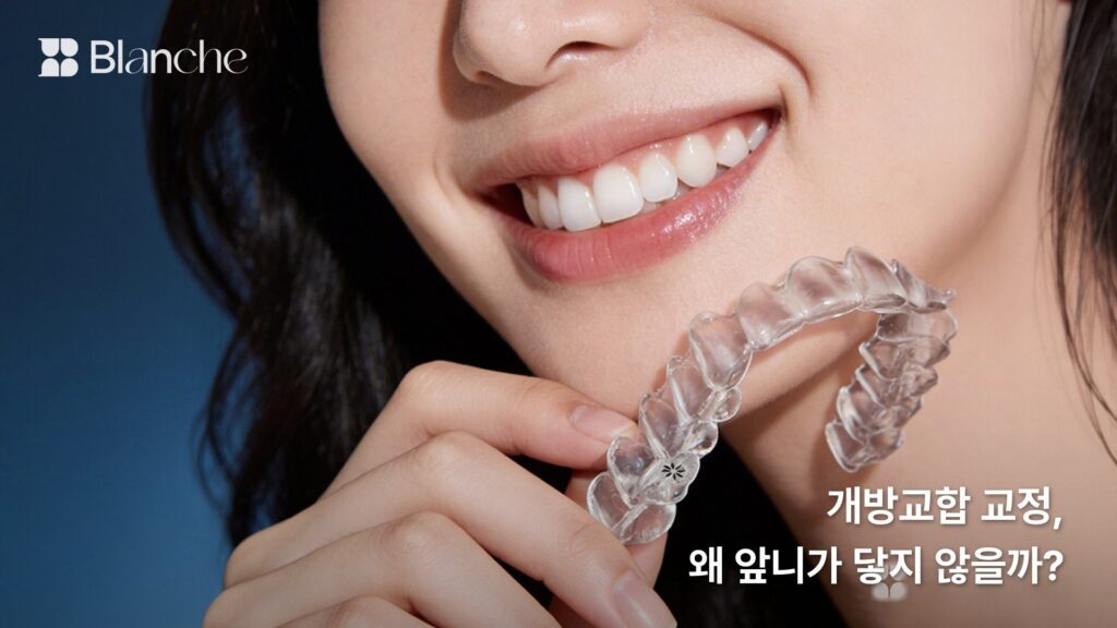 개방교합 교정, 왜 앞니가 닿지 않을까?